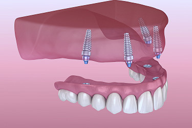 Implant Supported Dentures - Sparacino Periodontics